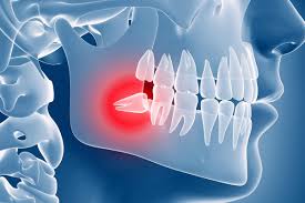 wisdom teeth removal 5 awesome tips