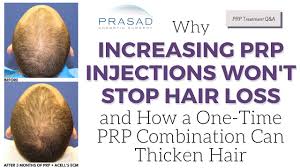 why increasing prp injections won t stop hair loss and one time treatment to thicken hair you