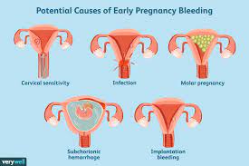 does early pregnancy bleeding mean a