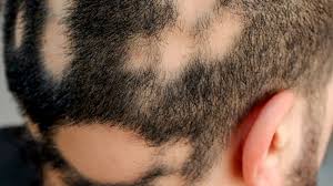 alopecia areata hair loss causes