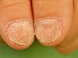 trachyonychia en twenty nail dystrophy
