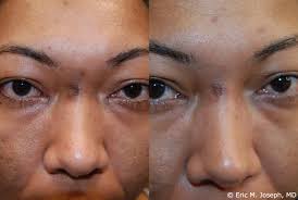 acne scar correction