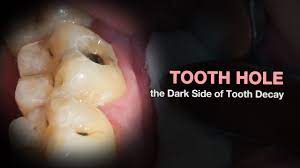 hole in the tooth you