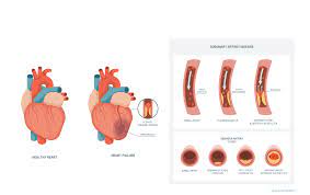coronary artery disease cad