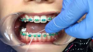Once it has been passed through this gap, you can proceed to floss as normal. Flossing With Braces Orthodontic Floss Other Options