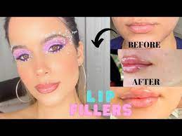 lips fillers experience before