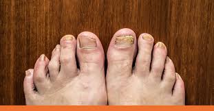 urgent care for toenail injuries