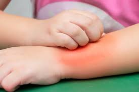 alleviating your child s itchy skin