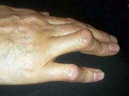 broken knuckle symptoms diagnosis