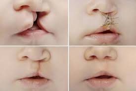 cleft lip and palate nhs