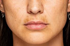 upper lip melasma how do you get rid