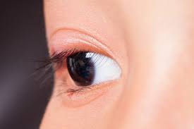 eye stye causes symptoms treatments