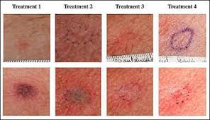 Laser Treatment Shows Promise For Skin Cancer Bioscan