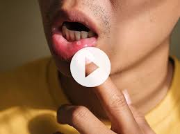 canker sores aphthous ulcer