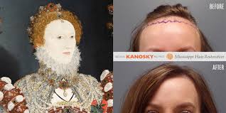kanosky mississippi hair restoration