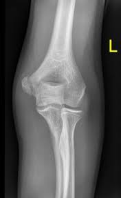The combination of firm palpation over the medial epicondyle and resisted flexion will likely elicit a familiar pain experienced by the patient over the medial epicondyle. Medial Epicondyle Fracture Radiology Reference Article Radiopaedia Org