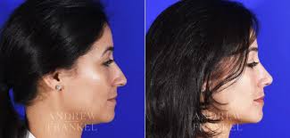 rhinoplasty recovery tips by expert surgeon