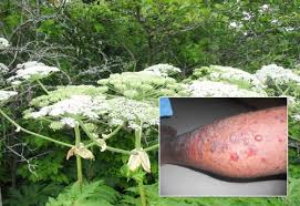 Giant Hogweed On Island Contact Burns Blisters Skin The