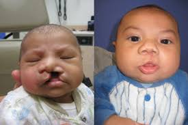 birth defects prevention month cleft