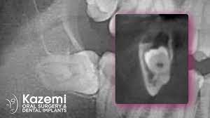 wisdom teeth partial extraction therapy
