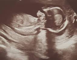 Im ultraschall ist inzwischen ein richtiger kleiner mensch zu sehen. Ultraschallbilder Mehr Als 50 Bilder Aus Der Schwangerschaft Faminino