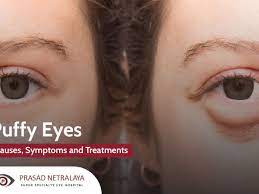 symptoms and treatments for puffy eyes