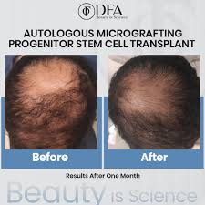 best hair stem cell therapy in stan