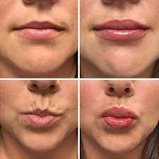 what to know about lip fillers and how