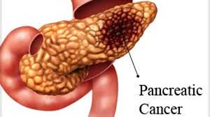 early signs of pancreatic cancer