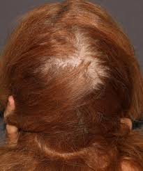 androgenetic alopecia aga in women