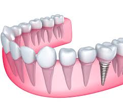 dental implants ontario canada risk