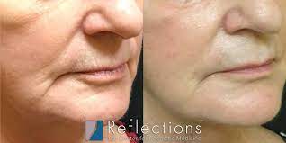marionette lines around mouth filler