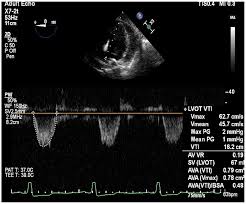 Asymptomatic Severe Aortic Stenosis And