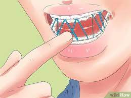 It has been observed that some people do it for 20 minutes! 5 Ways To Alleviate Orthodontic Brace Pain Wikihow