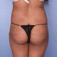 Anesthesia fee, and surgical facility fee. Brazilian Butt Lift Bbl Houston Tx Memorial Plastic Surgery