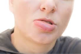 swollen lips cure that you can find at