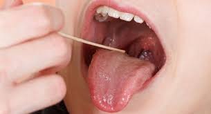 sore tongue here are 5 effective home