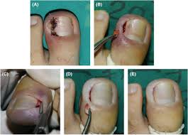 treating ingrown toenails