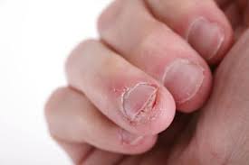 how to treat a torn nail howstuffworks