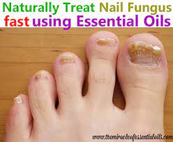 how to treat toenail fungus with