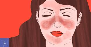 what is a lupus malar erfly rash