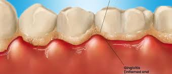 understanding gum disease causes