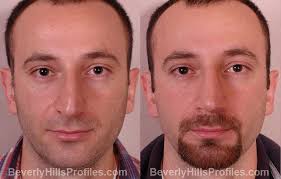 Maybe you would like to learn more about one of these? Rhinoplasty Before After Photos At Beverly Hills Profiles