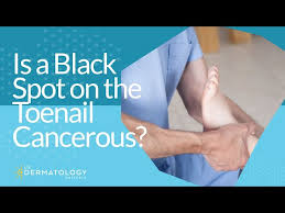 black spot on the toenail cancerous