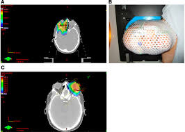 palliative radiotherapy for diffuse
