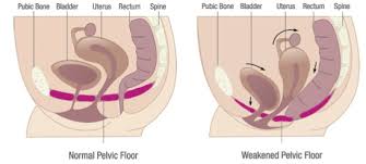 pelvic relaxation symptoms and