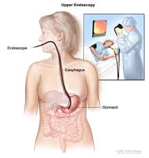 Stomach cancer can cause a blockage in the stomach. Gastric Cancer Treatment Pdq Treatment Patient Information Nci Cs Mott Children S Hospital Michigan Medicine