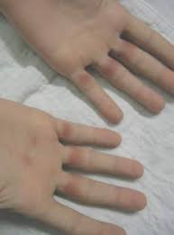 It occurs on both hands. Subcorneal Hematomas In Excessive Video Game Play Mdedge Dermatology