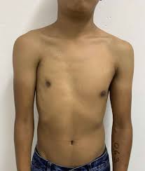 A 23 years old professional soccer player came to us to have right sided poland syndrome corrected. Poland Syndrome Causes Symptoms Diagnosis Treatment Prognosis
