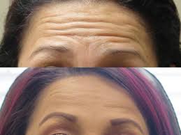what to do after botox in forehead a